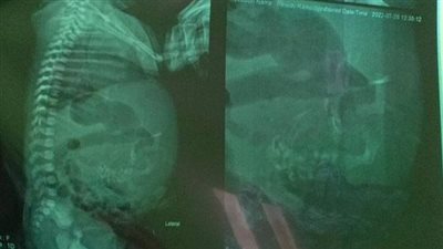 بالتفاصيل.. طبيب يكتشف حالة نادرة لطفلة تحمل بداخلها جنين بالدقهلية