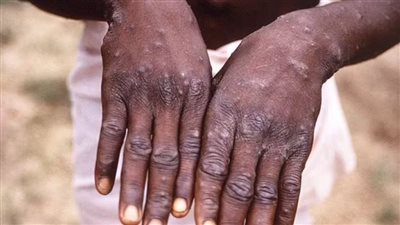 «الصحة العالمية»: للمرة الأولى جدري القرود خارج قارة إفريقيا 