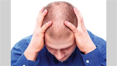 العلماء يكتشفون علاج محتمل لمرض الصلع 