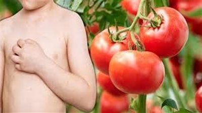 بحث يكشف أعراض حمى الطماطم عند الأطفال
