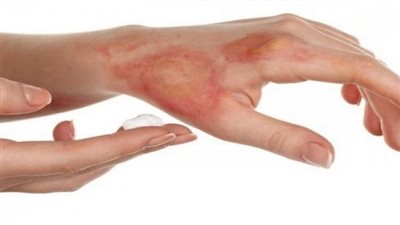 هيئة الدواء توضح الإجراءات الأولية لمعالجة الحروق