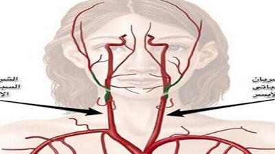 استشاري أوعية دموية يحذر من خطورة ضيق الشريان السباتي