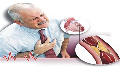 ما العوامل المؤدية إلى تصلب الشرايين؟.. هيئة الدواء تجيب