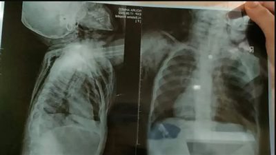 أطباء مستشفى بكفر الشيخ ينقذون حياة طفلة توقف قلبها