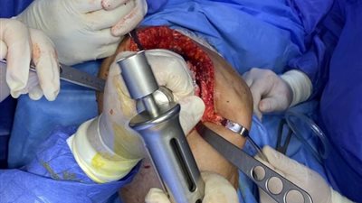 مستشفى أبو حماد المركزي تحقق إنجازا بمجال جراحات العظام المتقدمة