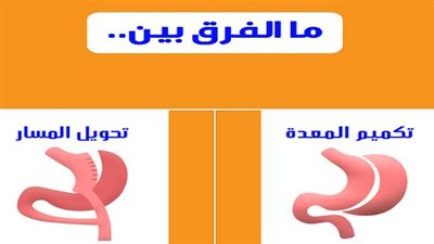 أستاذ بجراحات السمنة يكشف الفرق بين تكميم المعدة وتحويل المسار وتأثيرها على مرضى السكري