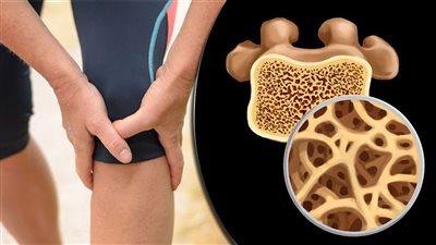 منها شرب الصودا.. أخطر 4 أسباب وراء الإصابة بمرض هشاشة العظام
