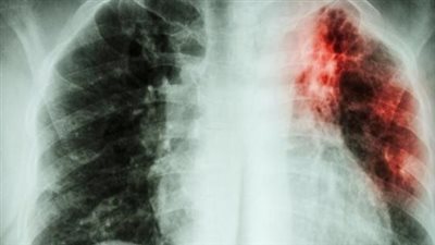 اطمن على نفسك.. تعرف على أعراض تليف الرئتين