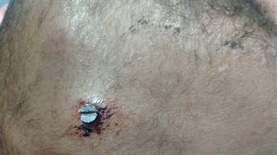 استخراج «مسمار» من رأس طفل بالمستشفى الجامعى بأسوان