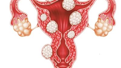 تظهر خلال فترة الإنجاب.. كل ما تريد معرفته عن الأورام الليفية