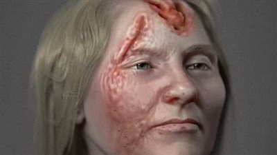 دراسة تاريخية تكشف عن آثار كارثية لمرض الزهري 