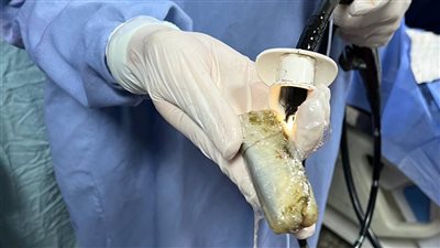 إنقاذ حياة شاب يبتلع هاتفا محمولا في المنصورة.. التفاصيل كاملة