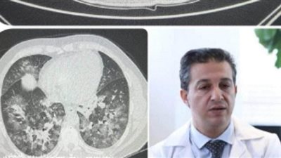 ماذا يفعل الفيروس التنفسي المخلوي في الرئة؟.. خبير يجيب 