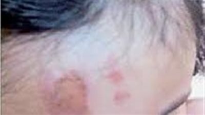 نزيف وحروق بجسدها.. شاهد عيان يروي لـ«النبأ» تفاصيل تعذيب أب لطفلته بنبروه