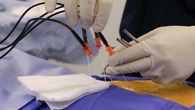 «التردد الحراري».. وسيلة جديدة لعلاج الأمراض المزمنة دون أدوية