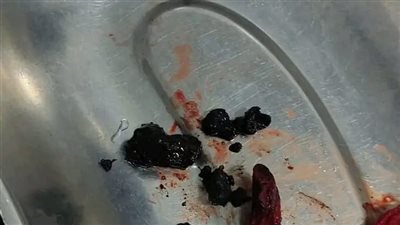  جسم غريب وراء استخراج مسمار من أنف طفل فى المنيا