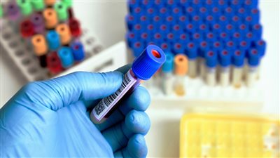 الهيموفيليا مرض وراثى يصيب ٢٥٠حالة سنويًا معظمهم من الأطفال 