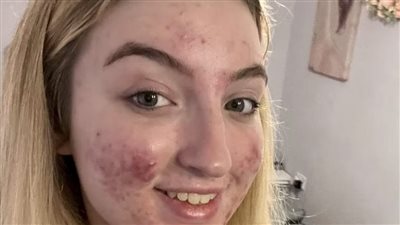 حذف حساب ملكة جمال المراهقين من منصة تيك توك بسبب حب الشباب!