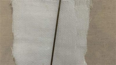 بسبب انسداد مجرى البول.. مريض يدخل جسما معدنيا في عضوه الذكري بالبحيرة