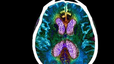 خطوات بسيطة في شبابك تحميك من أمراض الشيخوخة 