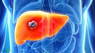 هذه العلامة تدل على الإصابة بفشل الكبد في مراحله الأخيرة