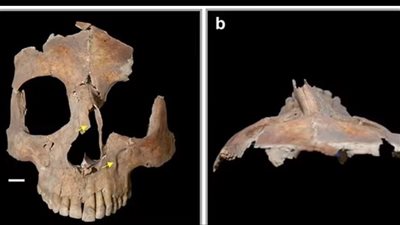 اكتشاف أثري يشير لإجراء عملية جراحية دقيقة قبل 3500 عام