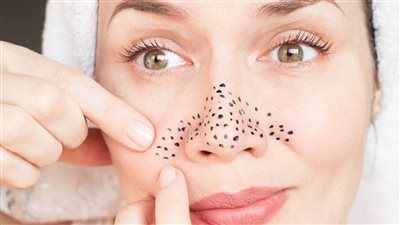 الرؤوس السوداء أسبابها وطرق علاجها