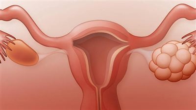 متلازمة تكيس المبايض وخطورتها على صحة المرأة
