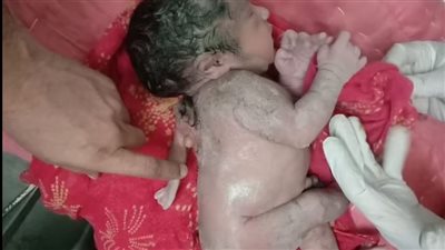 الهند.. ولادة طفل مخيف بذراع ثالثة تخرج من ظهره!