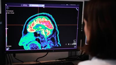 دراسة جديدة: عدم المساواة بين الجنسين يضر بأدمغة النساء