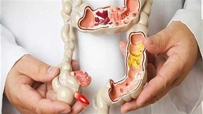  تعرف على ممنوعات مريض القولون العصبي