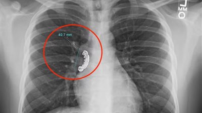 أطباء يعثرون على طقم من الأسنان الاصطناعية داخل مكان حساس بجسد رجل!