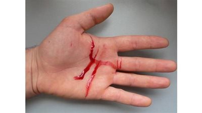 5 نصائح مهمة عند إصابتك بجرح بسيط