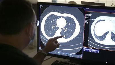 5 خرافات يجب أن تعرفها عن سرطان الرئة 