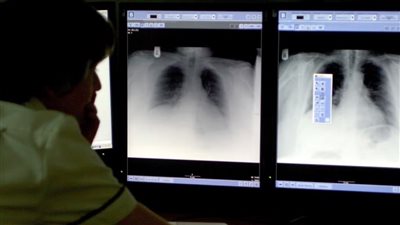 كيف يساعد الذكاء الاصطناعي في اكتشاف سرطان الثدي؟