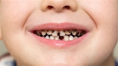 تلك العادة اليومية تدمر الأسنان أقوى مما تتخيل