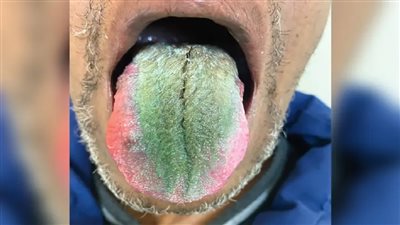 لسان رجل أمريكي يكسوه الشعر ويتحول للون الأخضر.. والسبب صادم