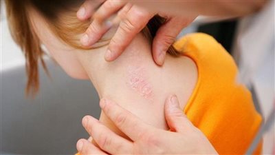 منها وضع كريم الترطيب.. نصائح مفيدة جدًا لمرضى الصدفية