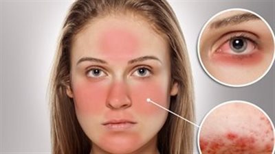 بالفيديو.. وصفة طبيعية لعلاج حروق البشرة وتفتيحها بعد المصيف