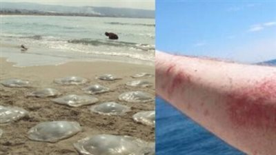 اعرفها.. الطريقة الصحيحة لعلاج لسعات قنديل البحر