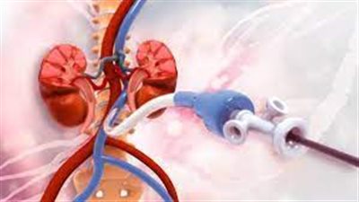 هيئة الدواء المصرية تجيب.. كيف تستعد لإجراء القسطرة التشخيصية؟