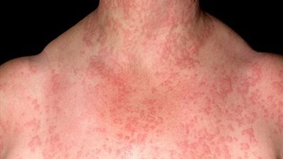 استشاري أمراض جلدية يكشف عن مرض نادر جدا في مصر 