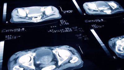 ما هي أعراض سرطان البروستاتا وما علاجه؟