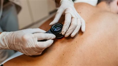 سرطان الجلد.. ما أسبابه وما أعراضه؟