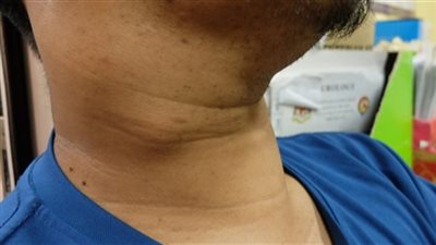 في اليوم العالمي لسرطان الغدد الليمفاوية.. كل ما تريد معرفته عن المرض 