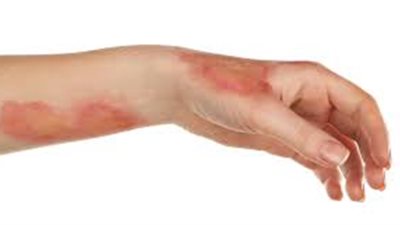 كيف يمكن التعامل مع مصاب الحروق؟.. هيئة الدواء تجيب