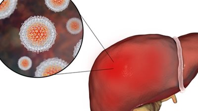 الصحة: مصر نجحت في علاج 4.5 مليون حالة مزمنة بفيروس سي 