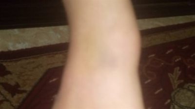 ثلاثة رجال يتسببون فى عاهة مستديمة لسيدة من البحيرة