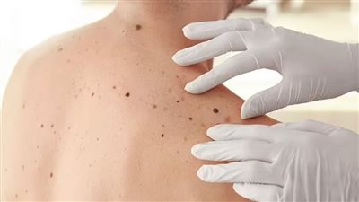 تطبيق ذكاء اصطناعي جديد يكشف بعض أنواع سرطان الجلد بطريقة فعالة