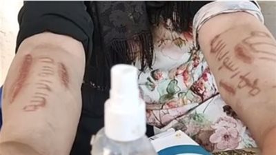 سيدة بالغربية تستغيث بالأطباء: جسمي كله متبهدل جروح قطعية تحمل لفظ الجلالة (فيديو)